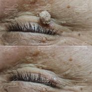 Лазерная деструкция кератомы на ножке