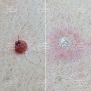 Лазерная деструкция невуса на спине