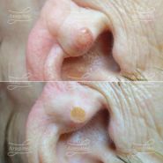 Лазерная деструкция невуса на ушной раковине