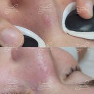 Коагуляция сосудов на спинке носа