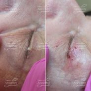 Удаление папиллом на веках