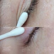 Удаление папиллом на ресничном краче века