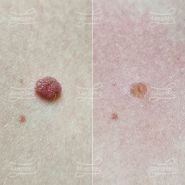 Удаление невуса области декольте (До и сразу После)