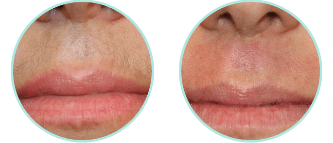 Как правильно удалить усики над губой?
